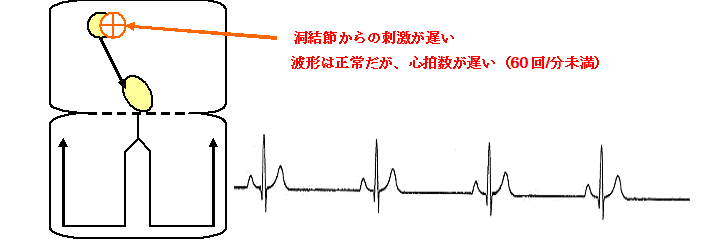 洞性徐脈の機序と心電図