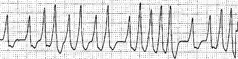 偽性心室頻拍（WPW＋AF）の機序と心電図